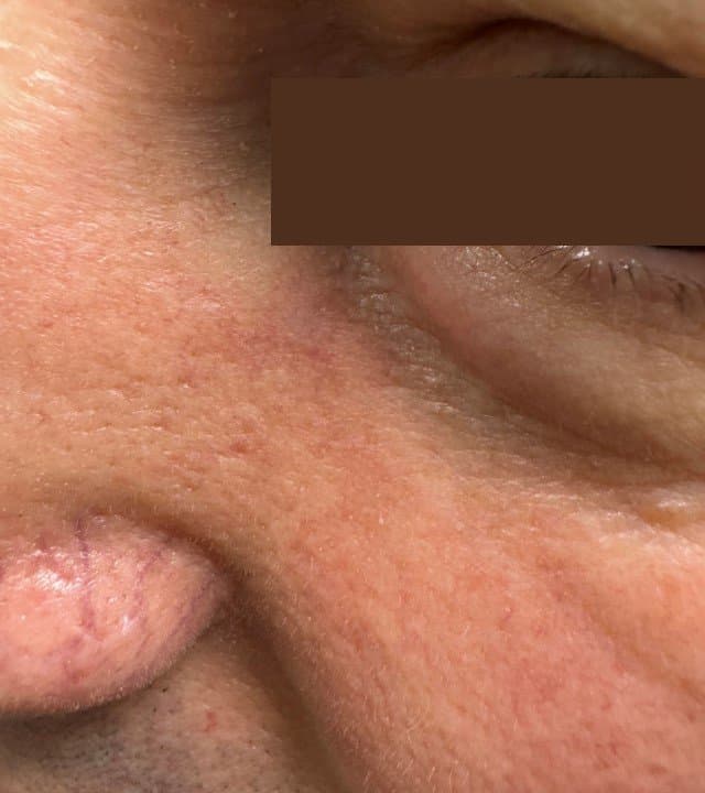 סבוראיק קרטוזיס - אחרי