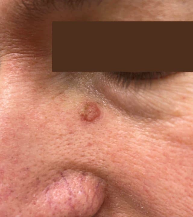 סבוראיק קרטוזיס - לפני