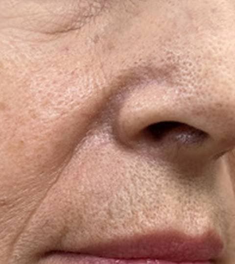 Seborrheic Keratosis - After