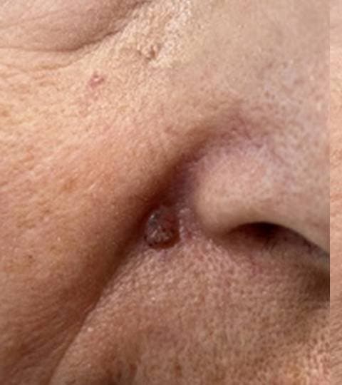 Seborrheic Keratosis - Before