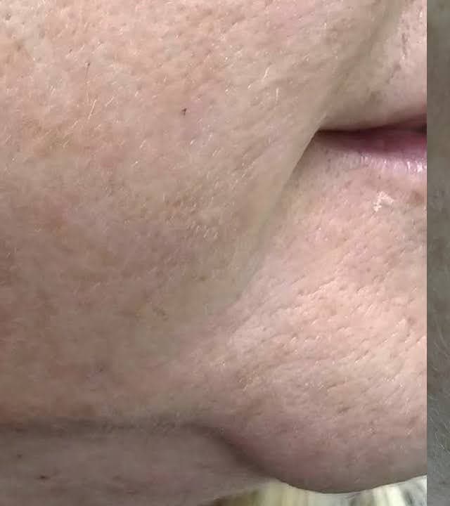 Nevus (Mole) - After