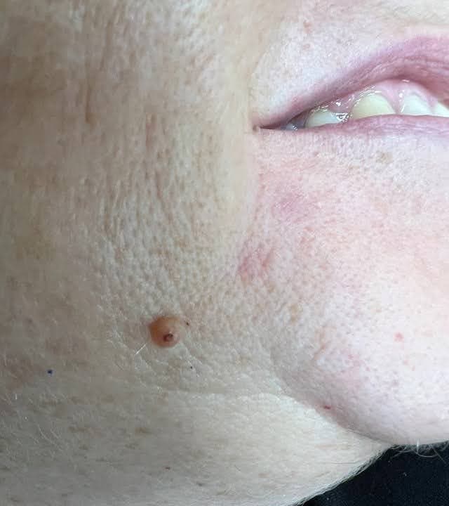 Nevus (Mole) - Before