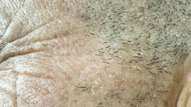 Seborrheic Keratoses - After