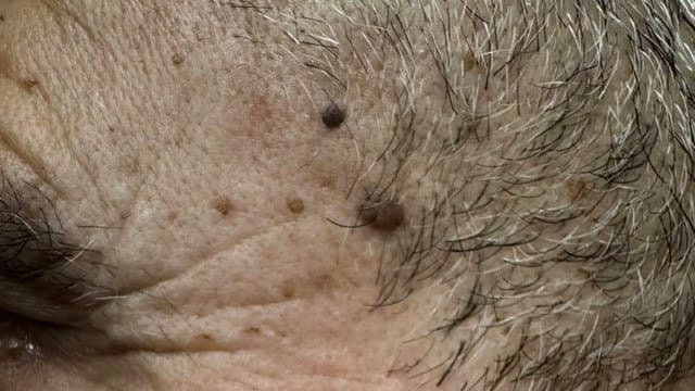 Seborrheic Keratoses - Before