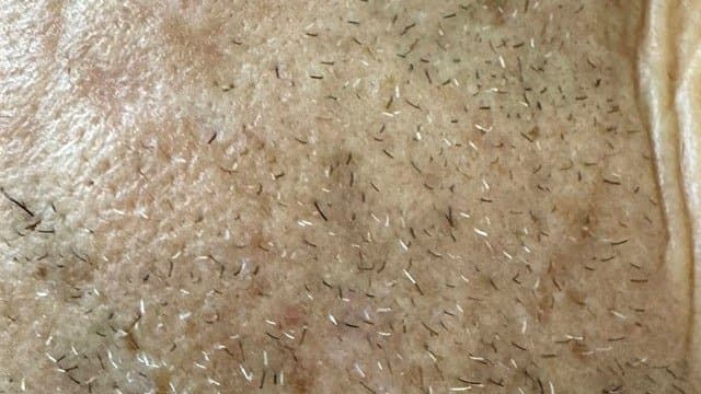 Seborrheic Keratoses - After