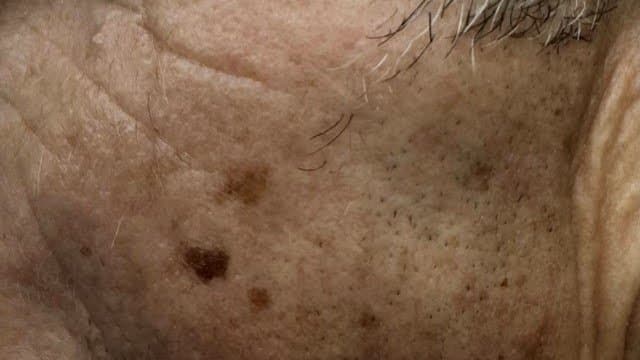 Seborrheic Keratoses - Before