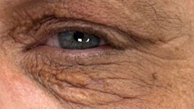 Xanthelasma - After