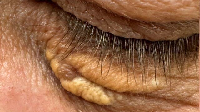 Xanthelasma - Before