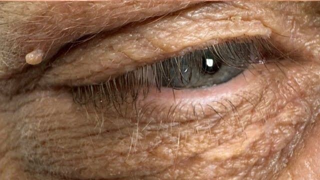 Xanthelasma - After