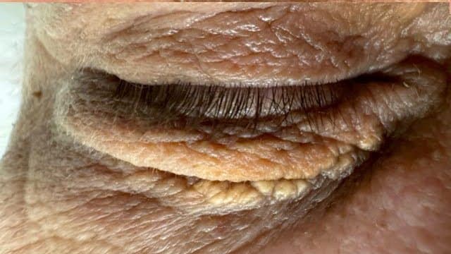 Xanthelasma - Before
