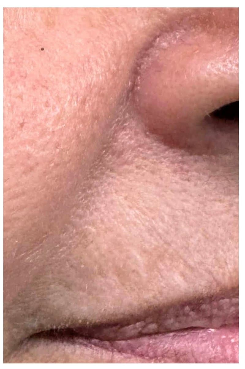 Nevus (Mole) - After