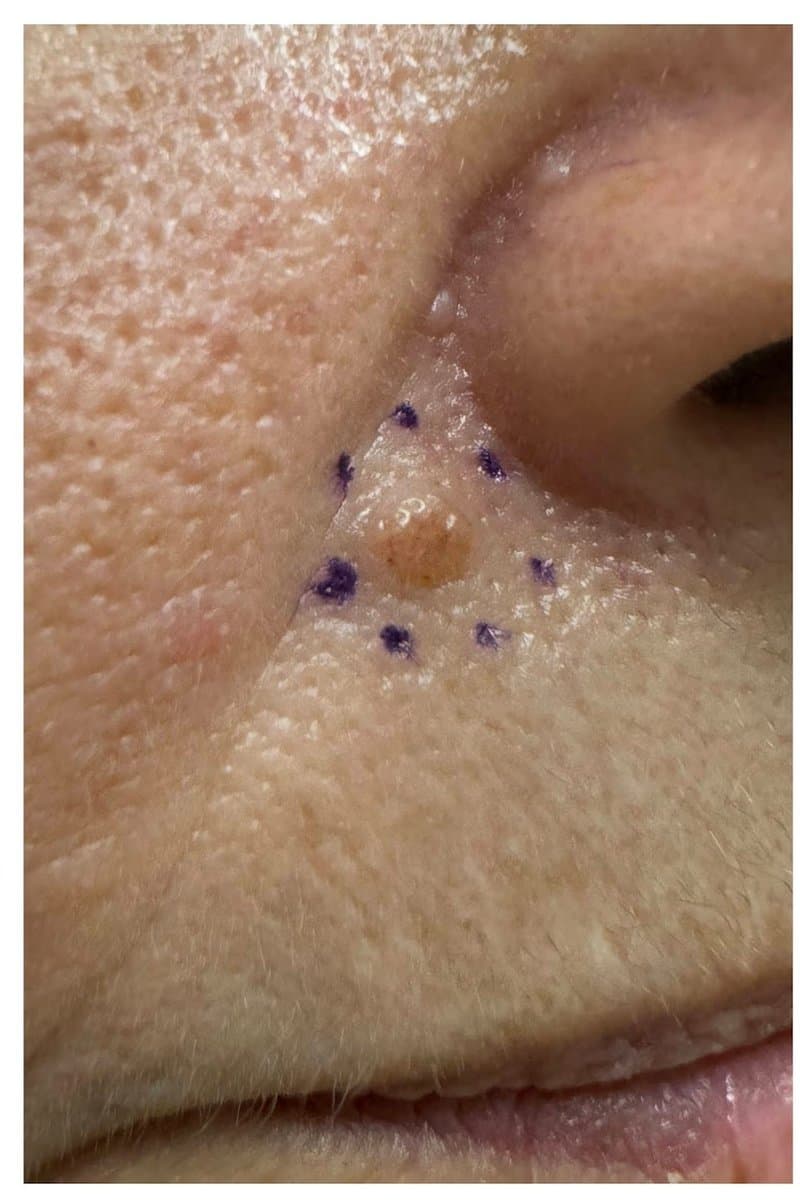 Nevus (Mole) - Before