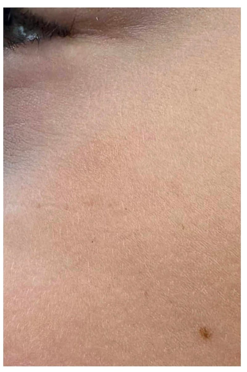 Angioma - After