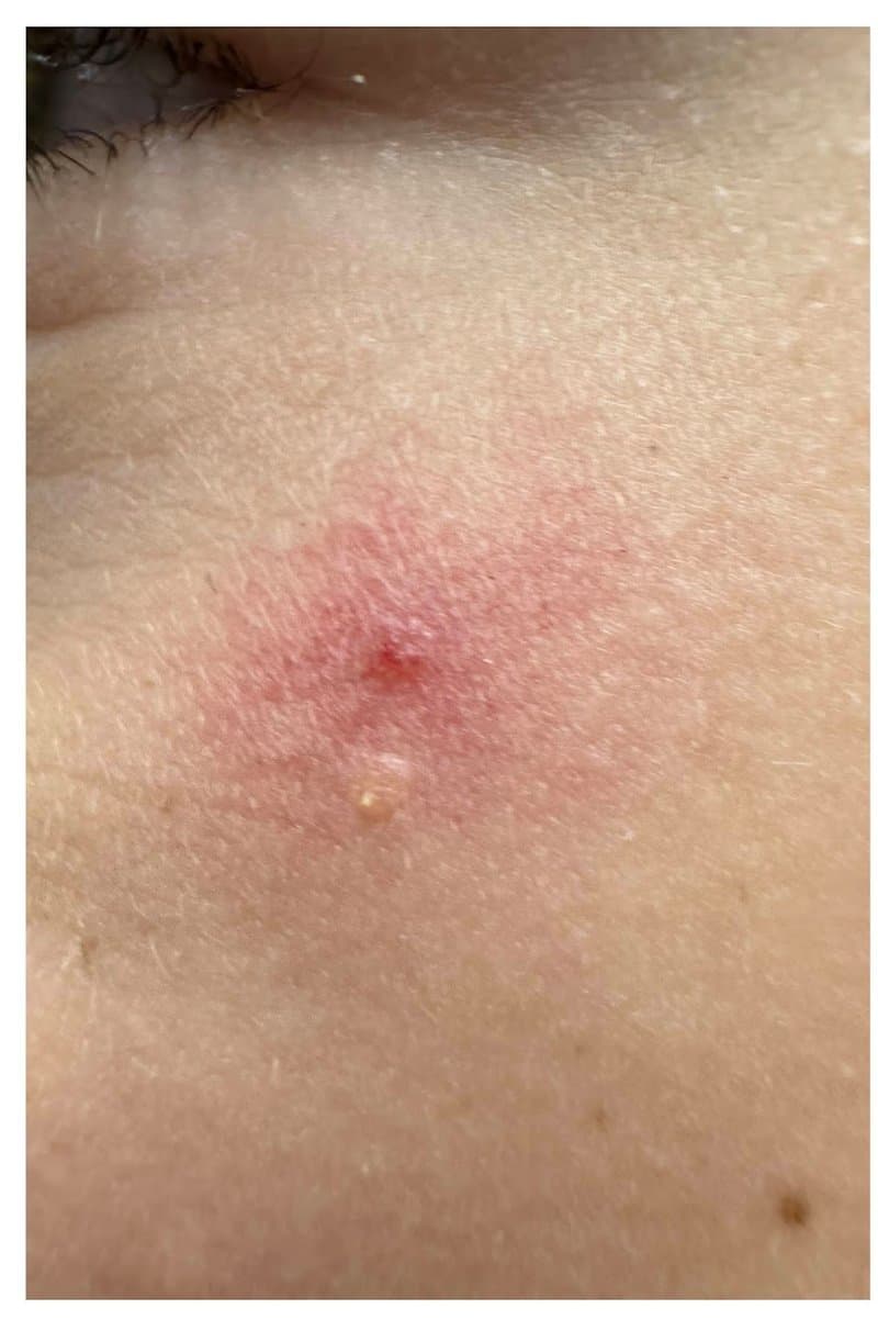 Angioma - Before