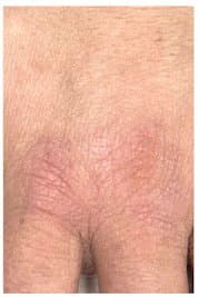 Viral Warts - After