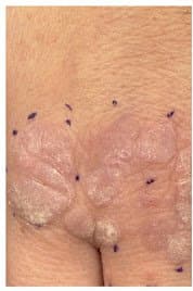 Viral Warts - Before