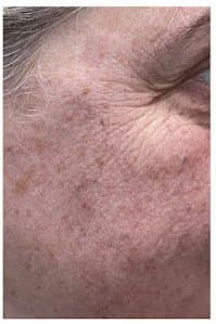 סבוראיק קרטוזות - אחרי