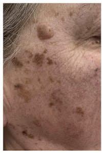 סבוראיק קרטוזות - לפני