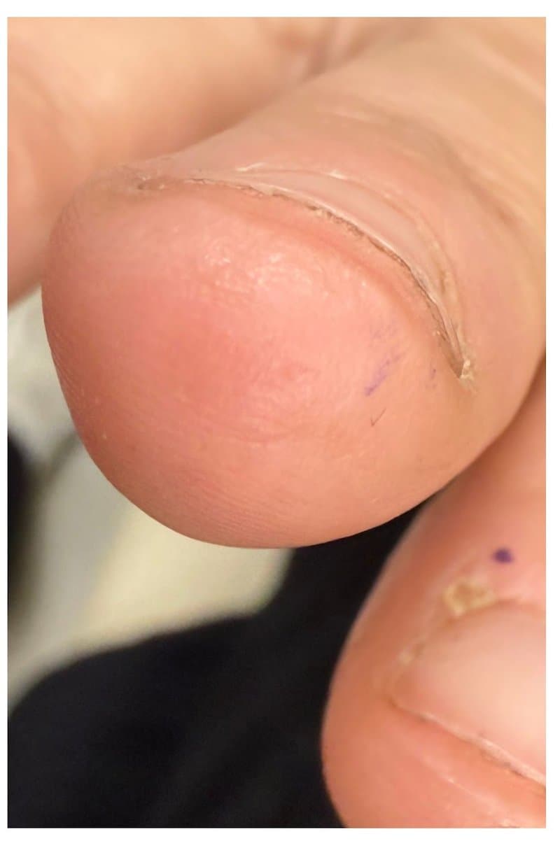 Viral Wart - After