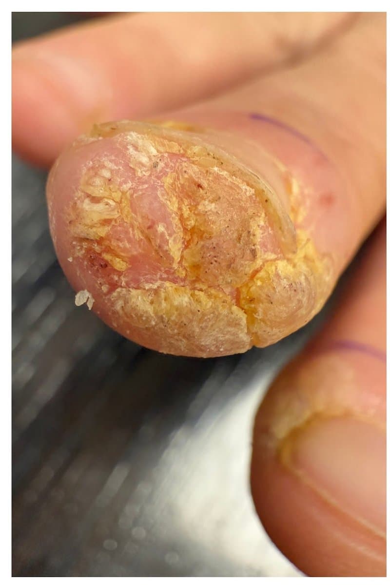 Viral Wart - Before