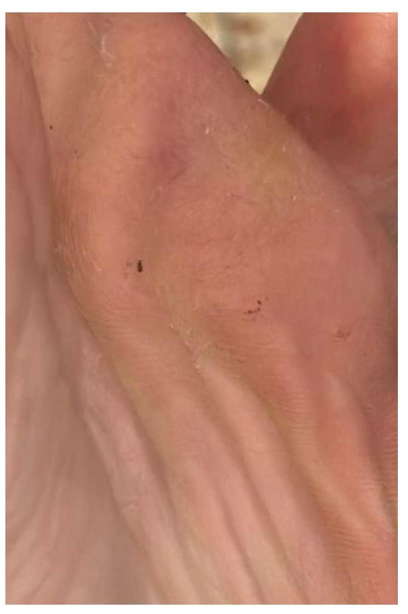 Plantar Wart - After