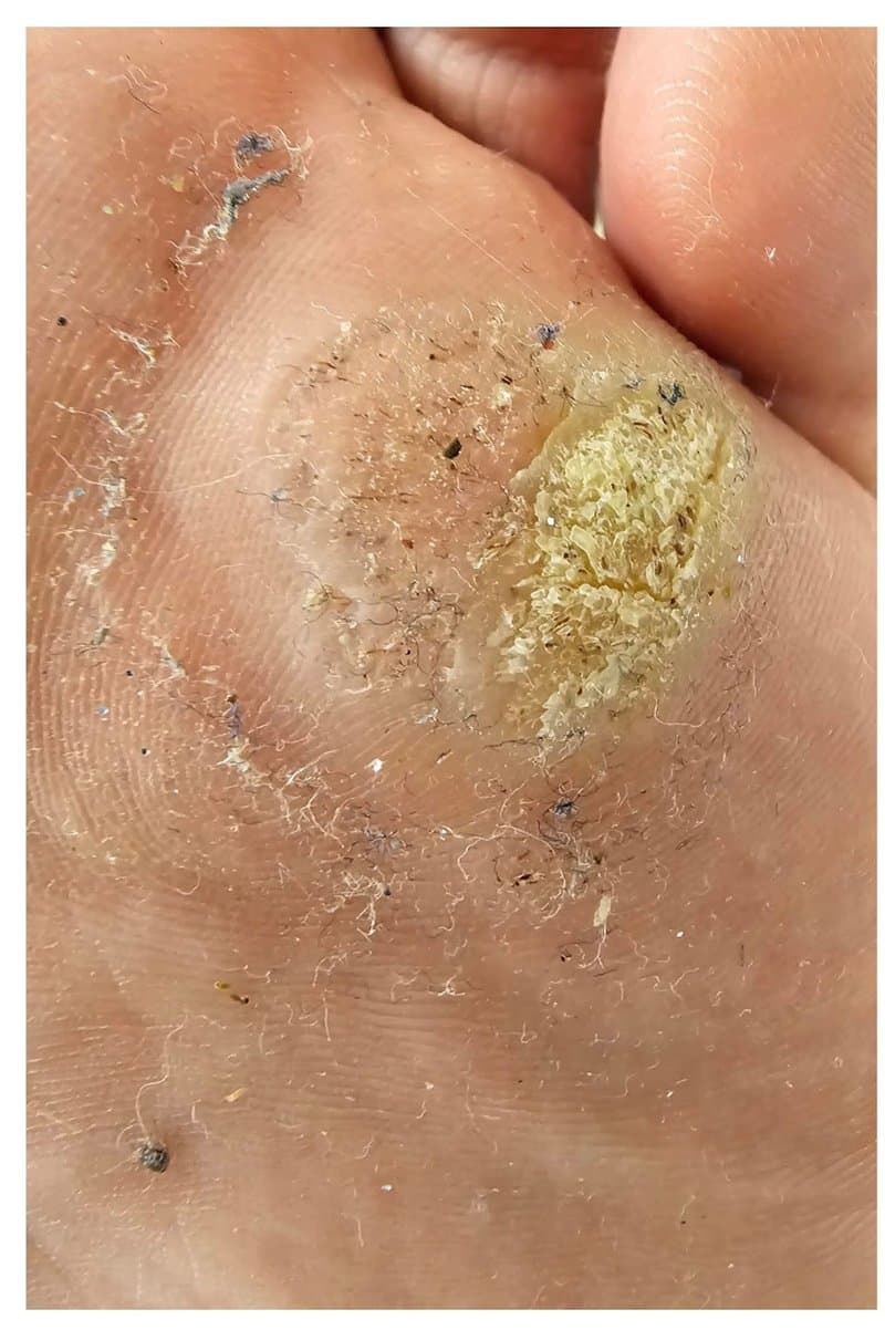 Plantar Wart - Before