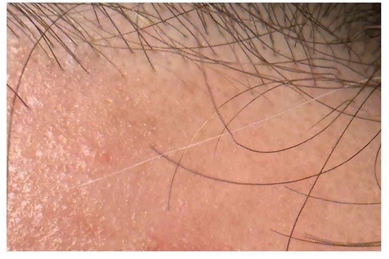 Seborrheic Keratosis - After