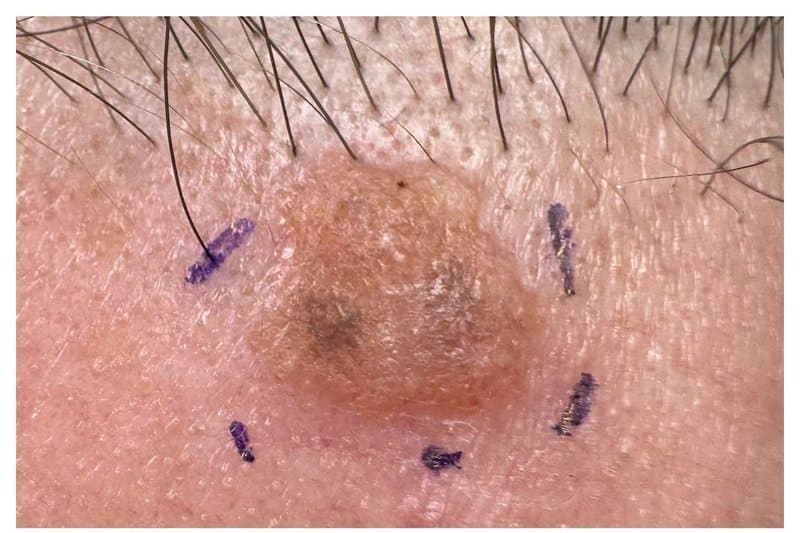 Seborrheic Keratosis - Before