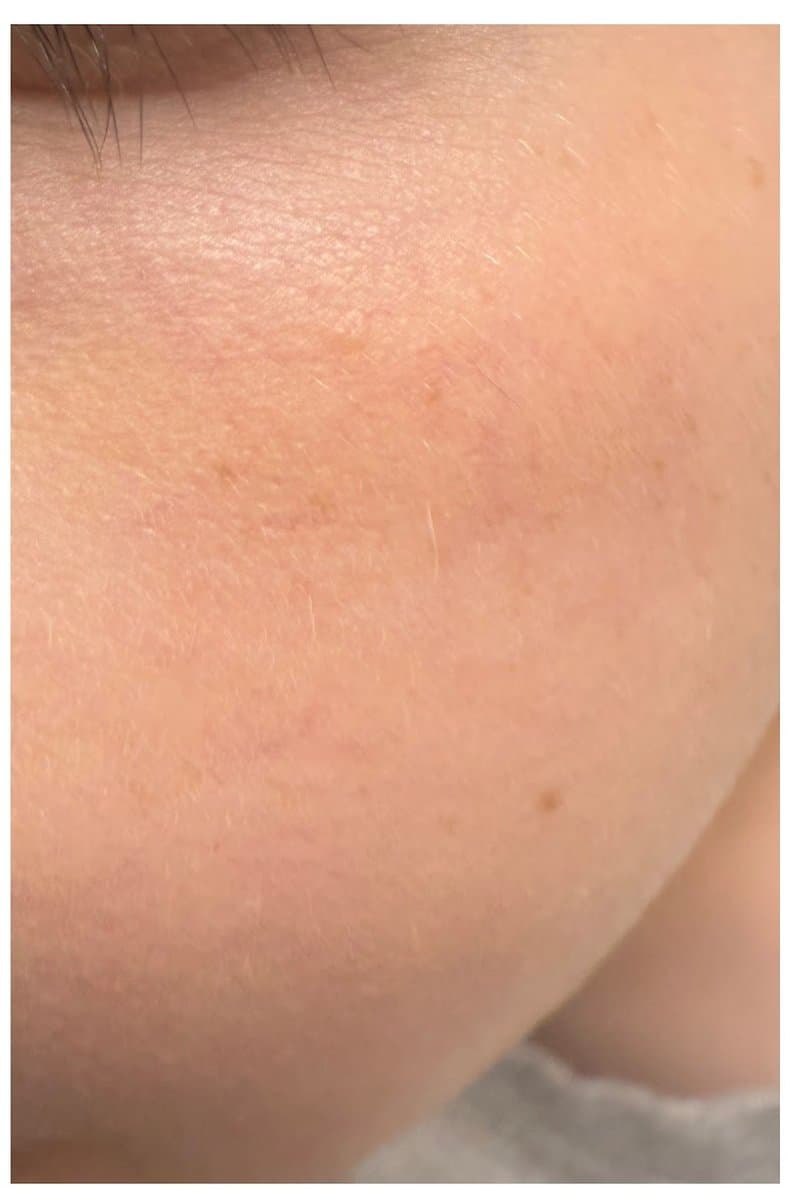 אנגיומת עכביש - אחרי