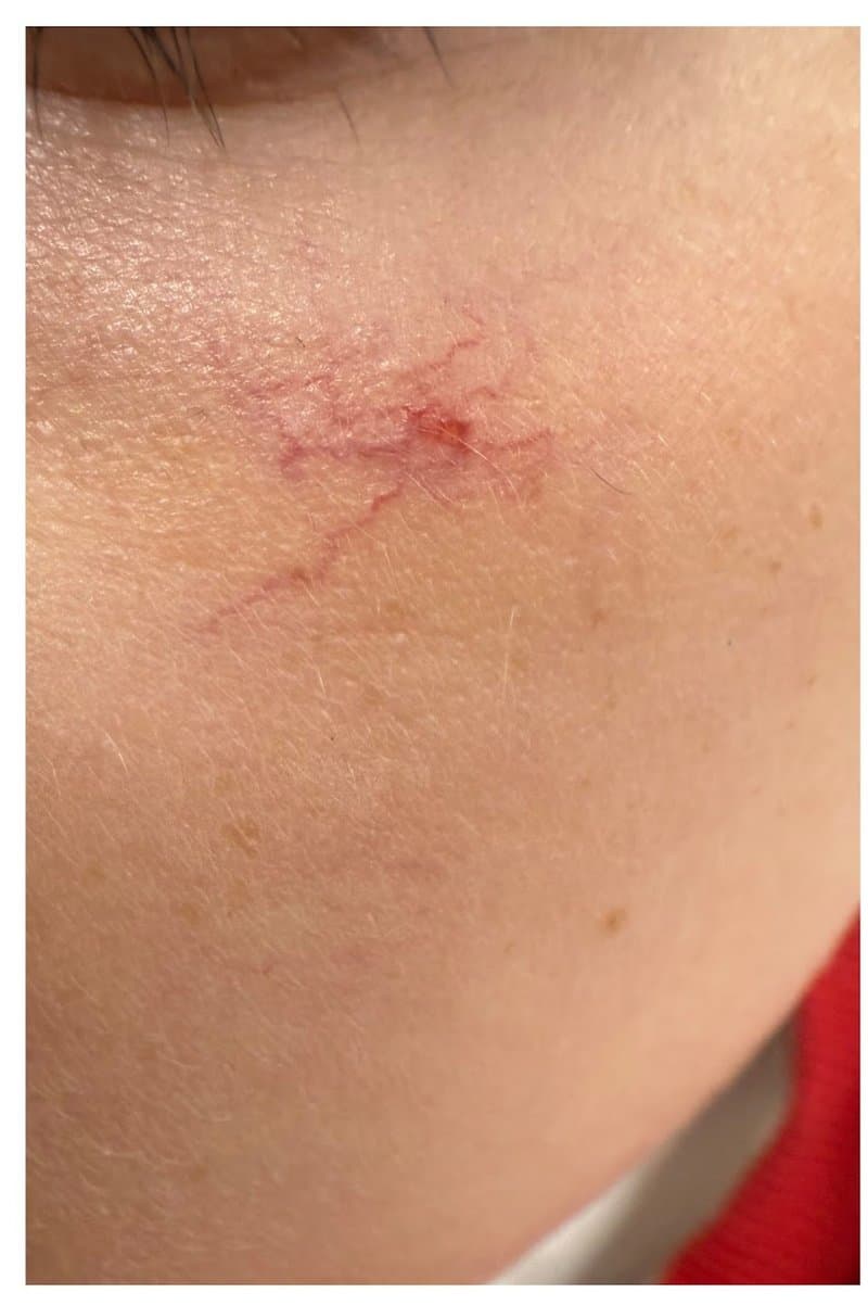 אנגיומת עכביש - לפני