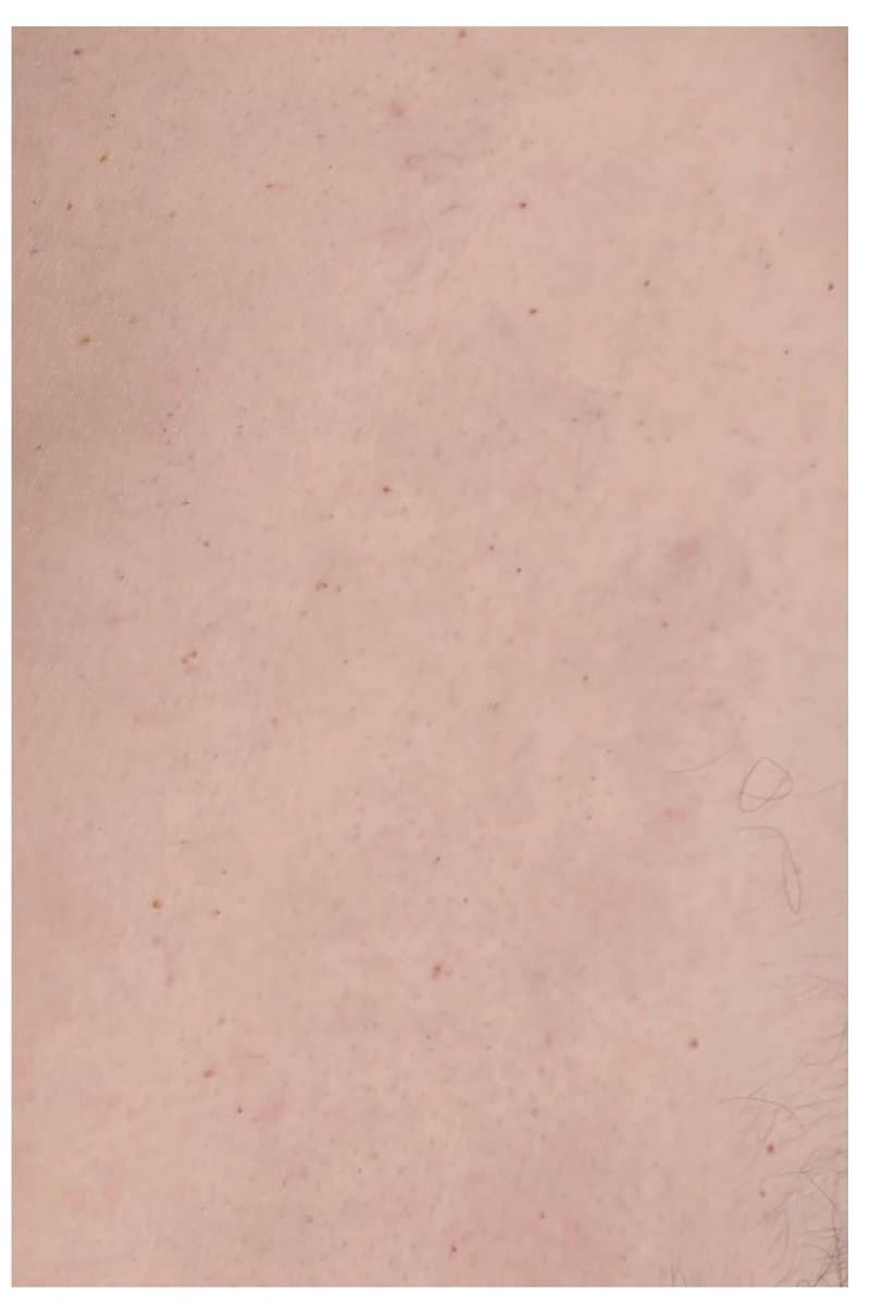 אנגיומות דובדבן - אחרי