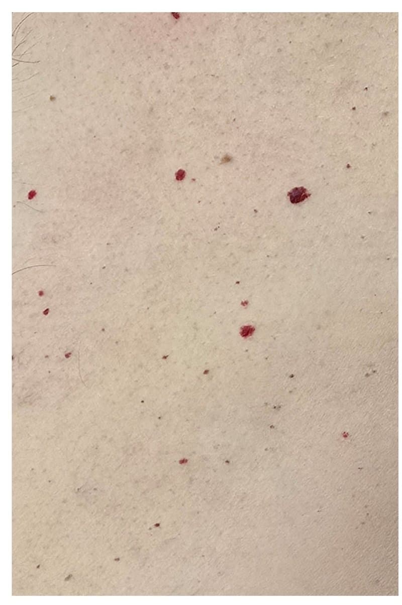 אנגיומות דובדבן - לפני