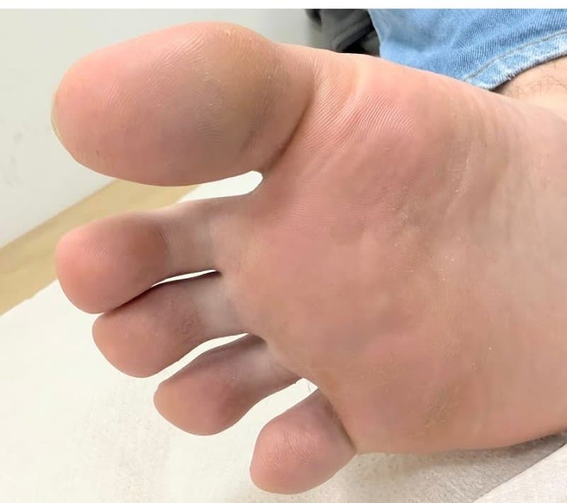 Plantar Warts - After