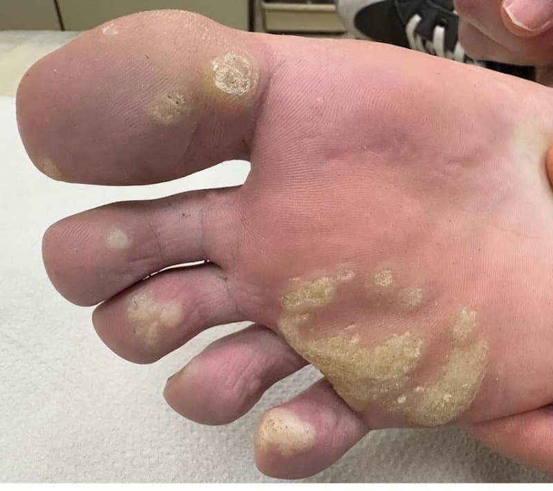 Plantar Warts - Before