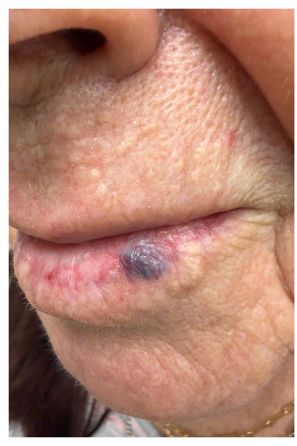Venous Lake - Before
