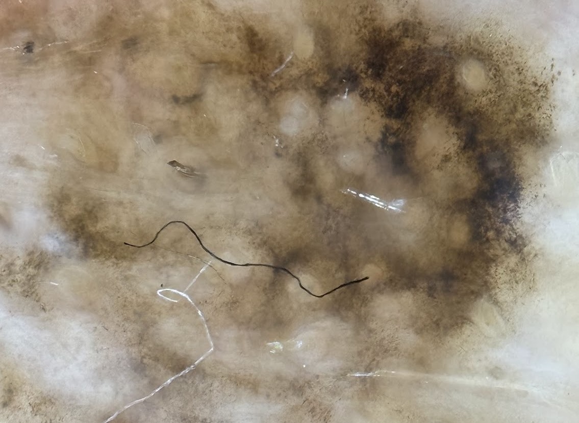 Dermoscopic melanoma image
